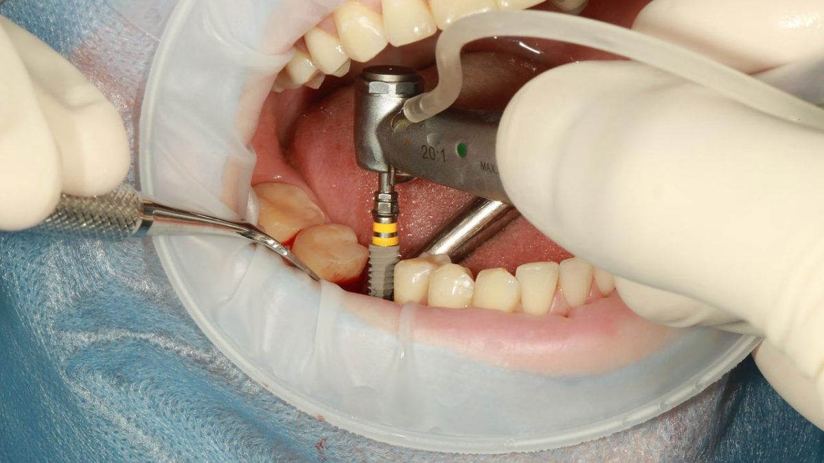 dvuhetapnaya-implantaciya-v-moskve